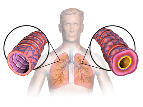 Asthma (Lungs)