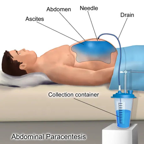 Abdominal Paracentesis illustration