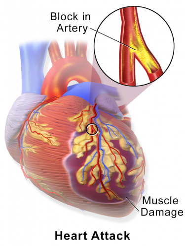 Heart Attack: Easy-to-Understand Myocardial Infarction Pathophysiology