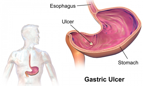 Gastric Ulcer chart illustration