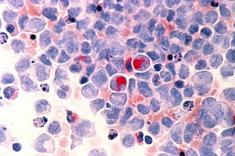 Leukemia cancer cells