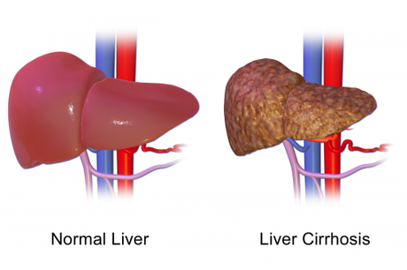 Healthy liver and Liver Cirrhosis