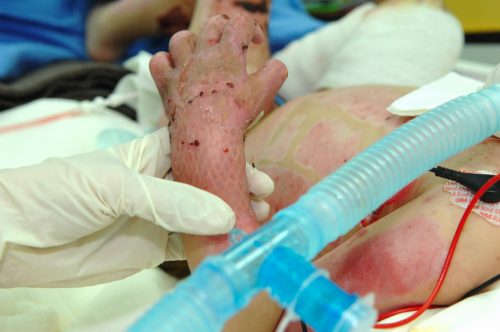 Little, but strong: burned Iraqi child overcomes odds
